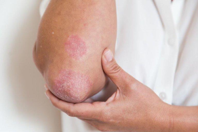 Bệnh chàm Eczema