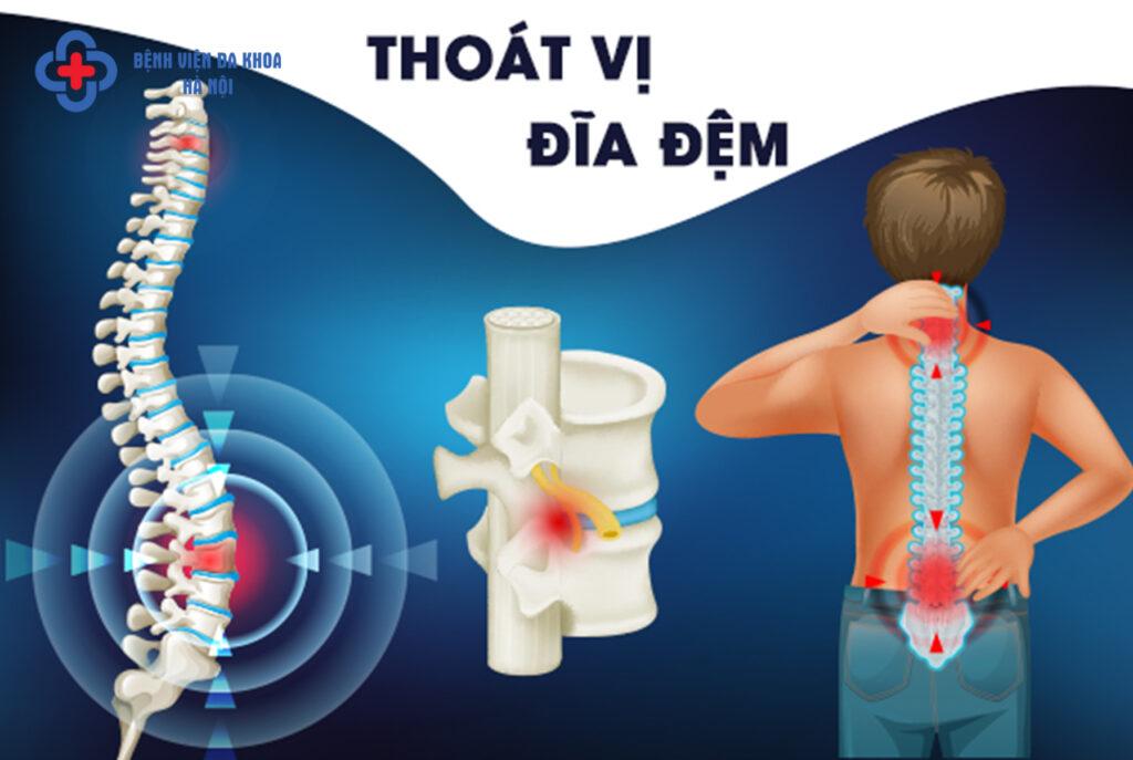 thoát vị đĩa đệm