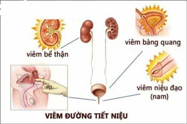 Viêm đường tiết niệu