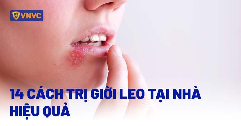 trị giời leo tại nhà