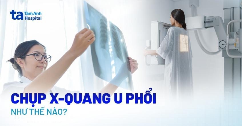 x quang u phổi