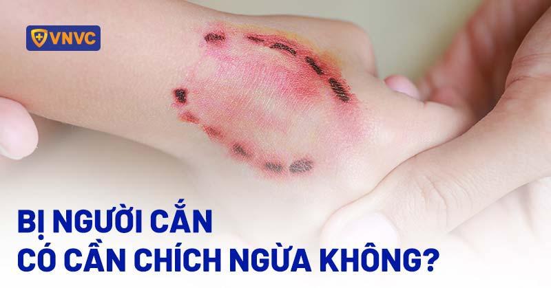 bị người cắn có cần chích ngừa không