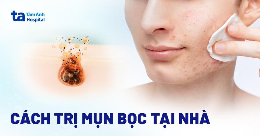 cách trị mụn bọc tại nhà