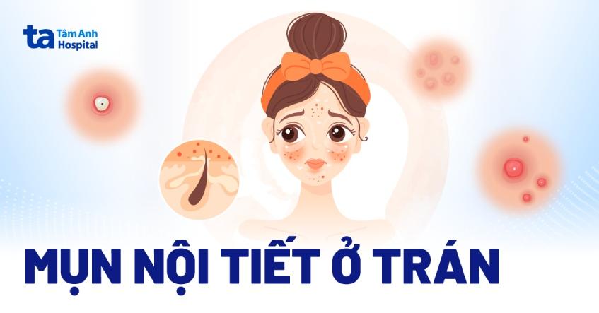 Mụn nội tiết ở trán