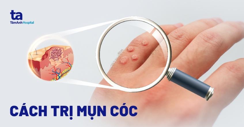 cách trị mụn cóc