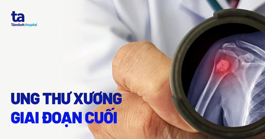 ung thư xương giai đoạn cuối