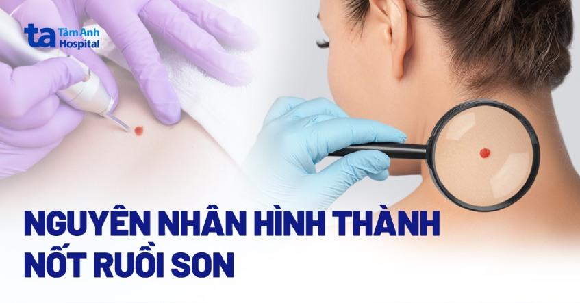 Nốt ruồi son là gì? Có hại không? Nguyên nhân hình thành