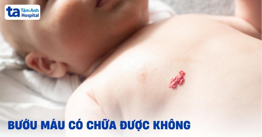 Bướu máu có chữa được không? Có tự khỏi hoàn toàn không?