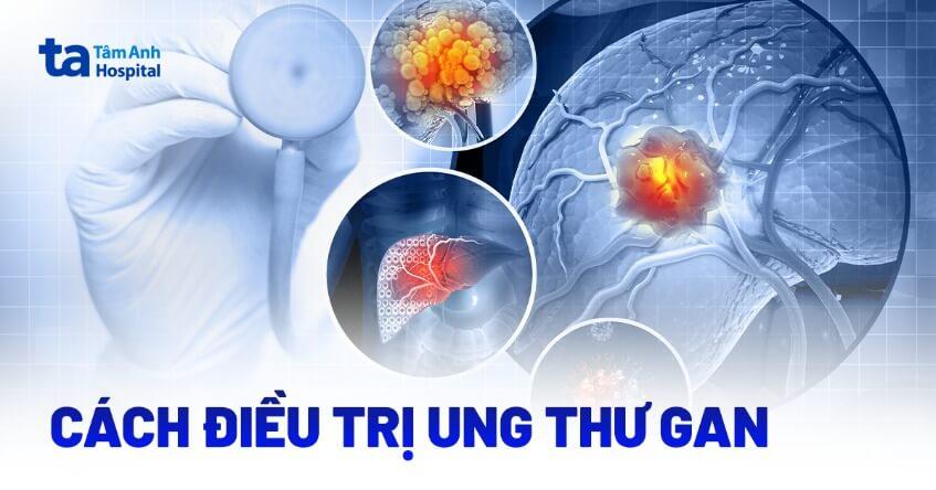 điều trị ung thư gan