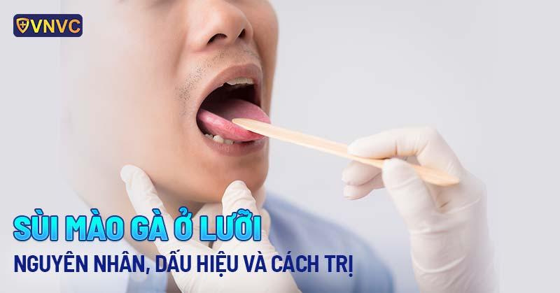 Sùi mào gà ở lưỡi: Nguyên nhân, dấu hiệu và cách trị