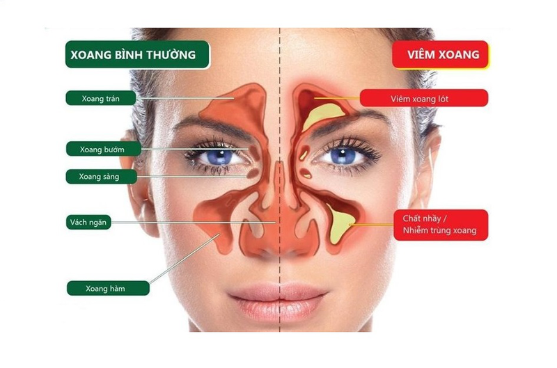 Mách bạn cách chữa viêm xoang có mủ tại nhà an toàn, hiệu quả