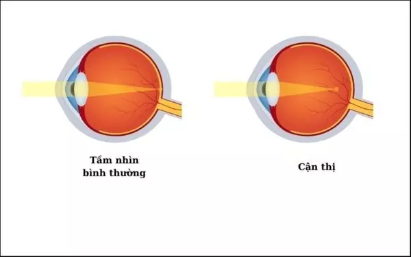 Mắt cận có giảm độ được không? Cách hạn chế tối đa tăng cận