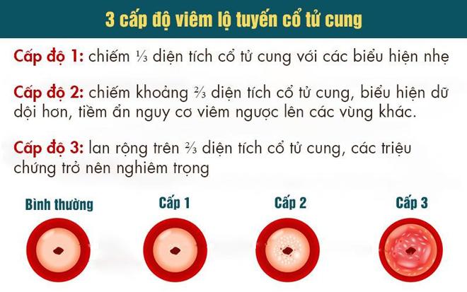 Tất tần tật về Viêm lộ tuyến cổ tử cung? Ưu nhược điểm của đốt diệt tuyến