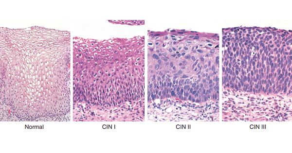 Cin 1,2,3 cổ tử cung là gì