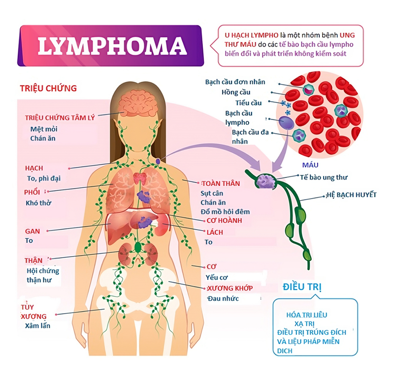 Ung thư hạch bạch huyết là gì? Nguyên nhân và một số lưu ý về bệnh cần biết 1