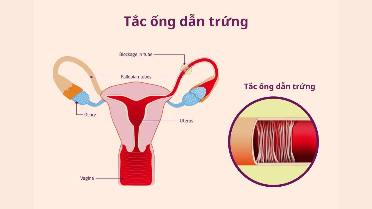 (Hình 1 - Mổ nội soi vòi trứng là phương pháp dành cho các chị em bị tắc vòi trứng)