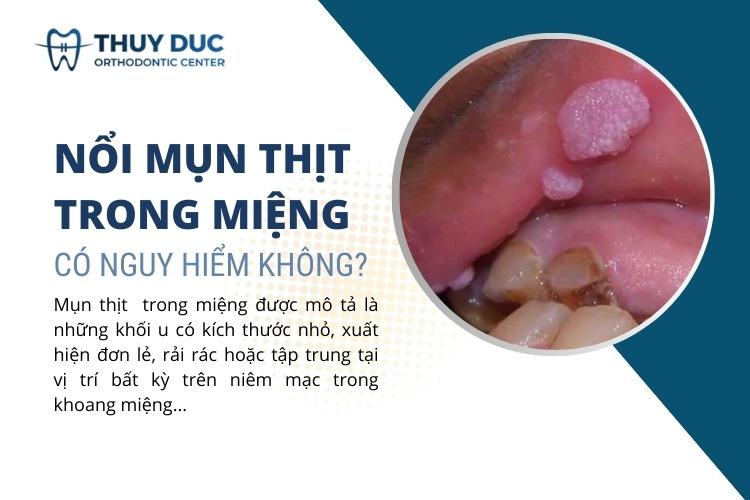 Nổi mụn thịt trong miệng không đau có nguy hiểm không? 1