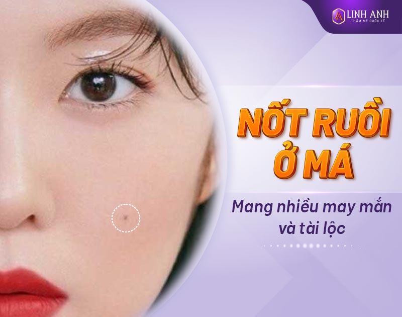 nốt ruồi trên má