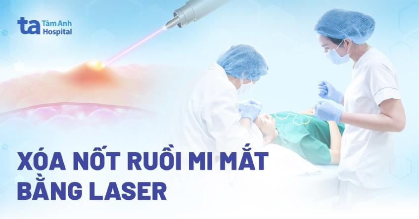 xóa nốt ruồi mi mắt bằng laser