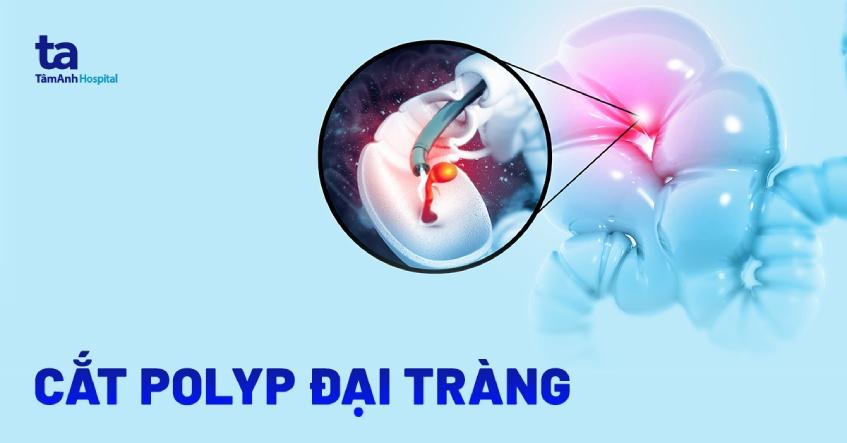 mổ polyp đại tràng