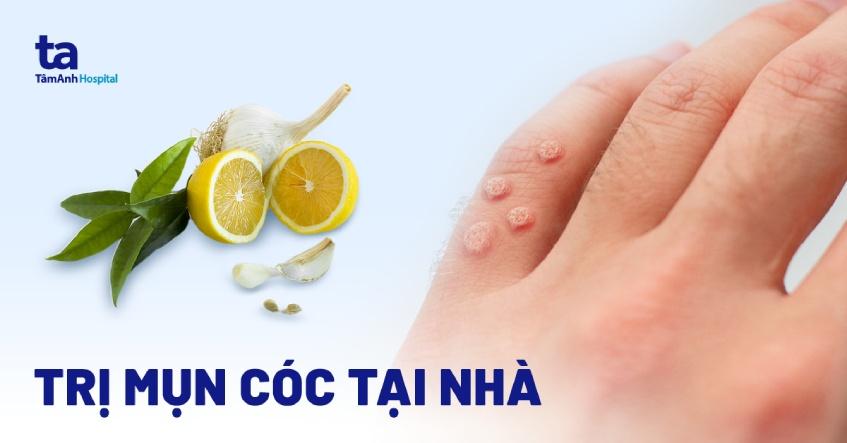 13 cách trị mụn cóc tại nhà dân gian hiệu quả, an toàn và đơn giản