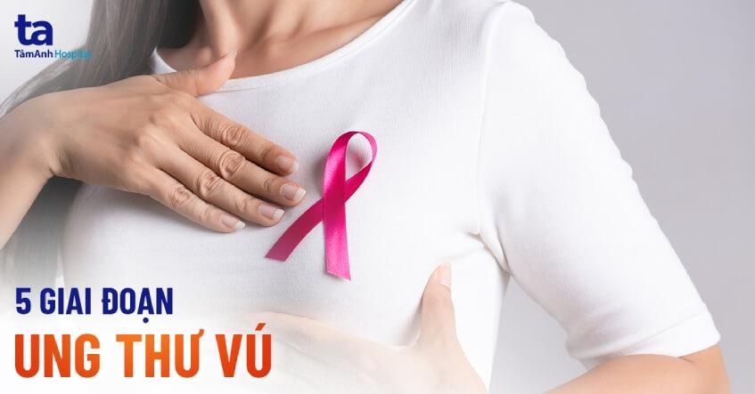 5 giai đoạn ung thư vú chị em phụ nữ cần hiểu thật chi tiết