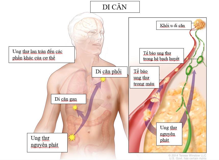 TÌM HIỂU VỀ UNG THƯ DI CĂN