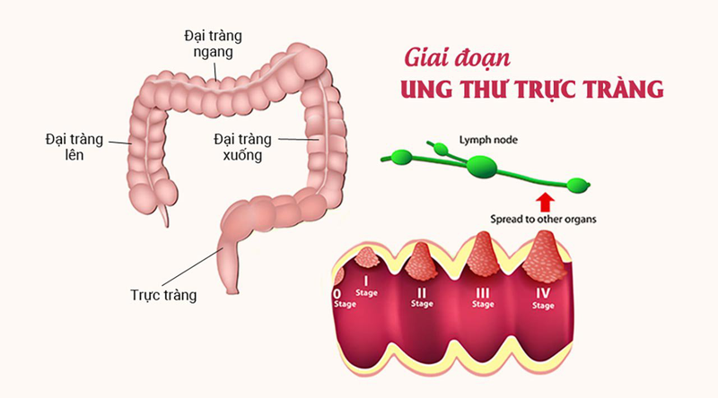 Thế nào là ung thư đại tràng giai đoạn 2? Dấu hiệu ung thư đại tràng giai đoạn 2 là gì?