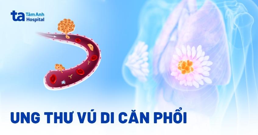 ung thư vú di căn phổi