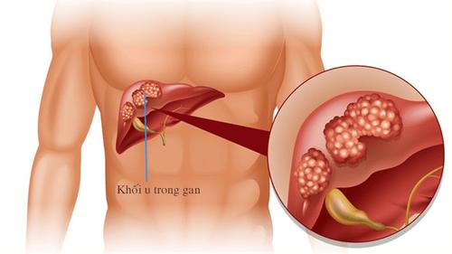 Những điều cơ bản cần biết về ung thư