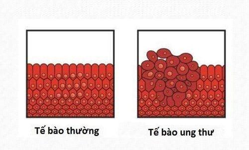 Ung thư là gì? Sự khác biệt giữa tế bào ung thư và tế bào bình thường