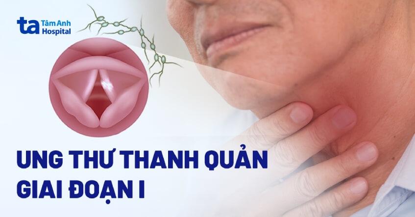 Ung thư thanh quản giai đoạn I: Triệu chứng, chẩn đoán và điều trị 