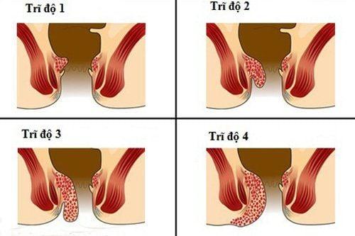 Trĩ nội độ 3 có cần phẫu thuật?