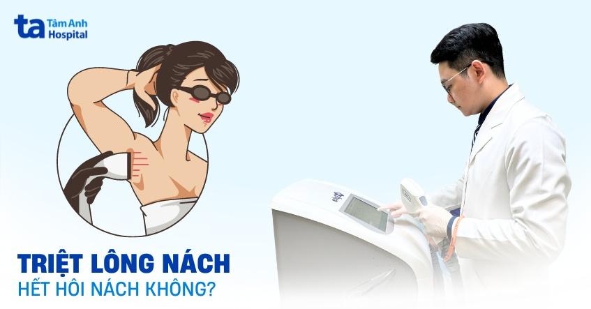 Triệt lông nách có hết hôi nách không? Có giảm mùi được không?