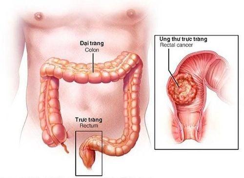 Phân biệt dấu hiệu ung thư đại tràng, ung thư hậu môn và bệnh trĩ