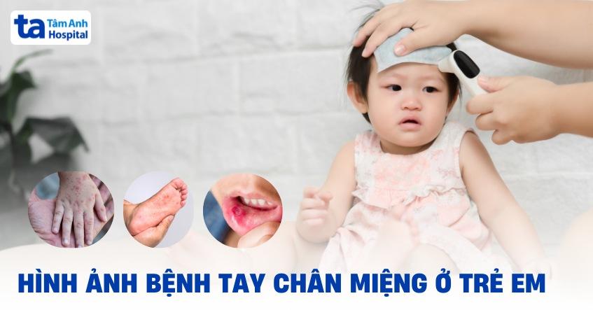 Hình ảnh bệnh tay chân miệng ở trẻ em cha mẹ nên nhận biết sớm