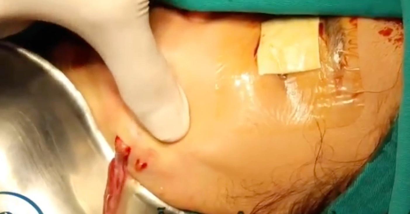 Sốc: Mù mắt, cắt bỏ tuyến vú, sẹo lồi lõm... vì tiêm filler làm đẹp