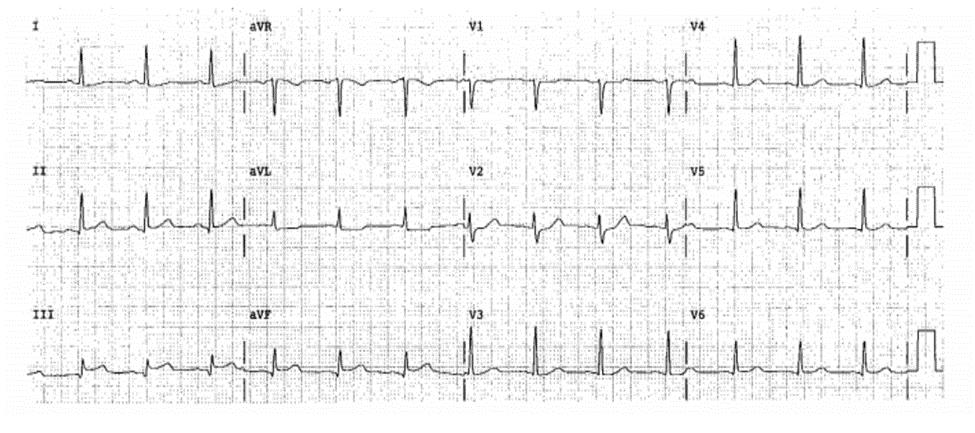 St chênh xuống soi gương