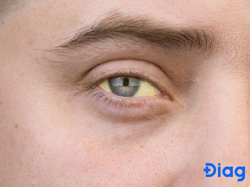 12 dấu hiệu bệnh gan đặc trưng: Cách nhận biết các bệnh về gan