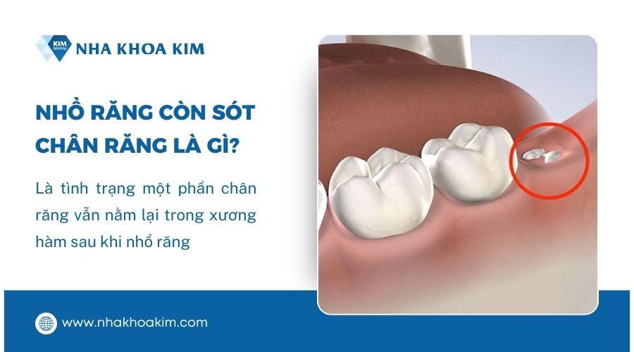 Nhổ răng còn sót chân răng có sao không? Cách xử lý an toàn