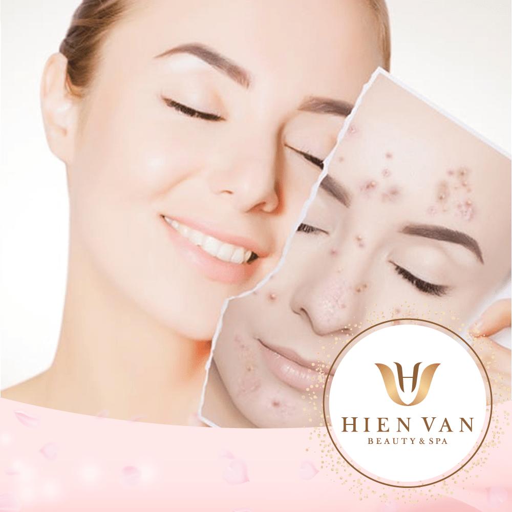 [Spa giải đáp] Điều trị mụn xong có hết hẵn hay vẩn bị mọc lại nữa