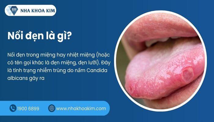Nổi đẹn là gì? Nguyên nhân và cách điều trị đẹn lưỡi