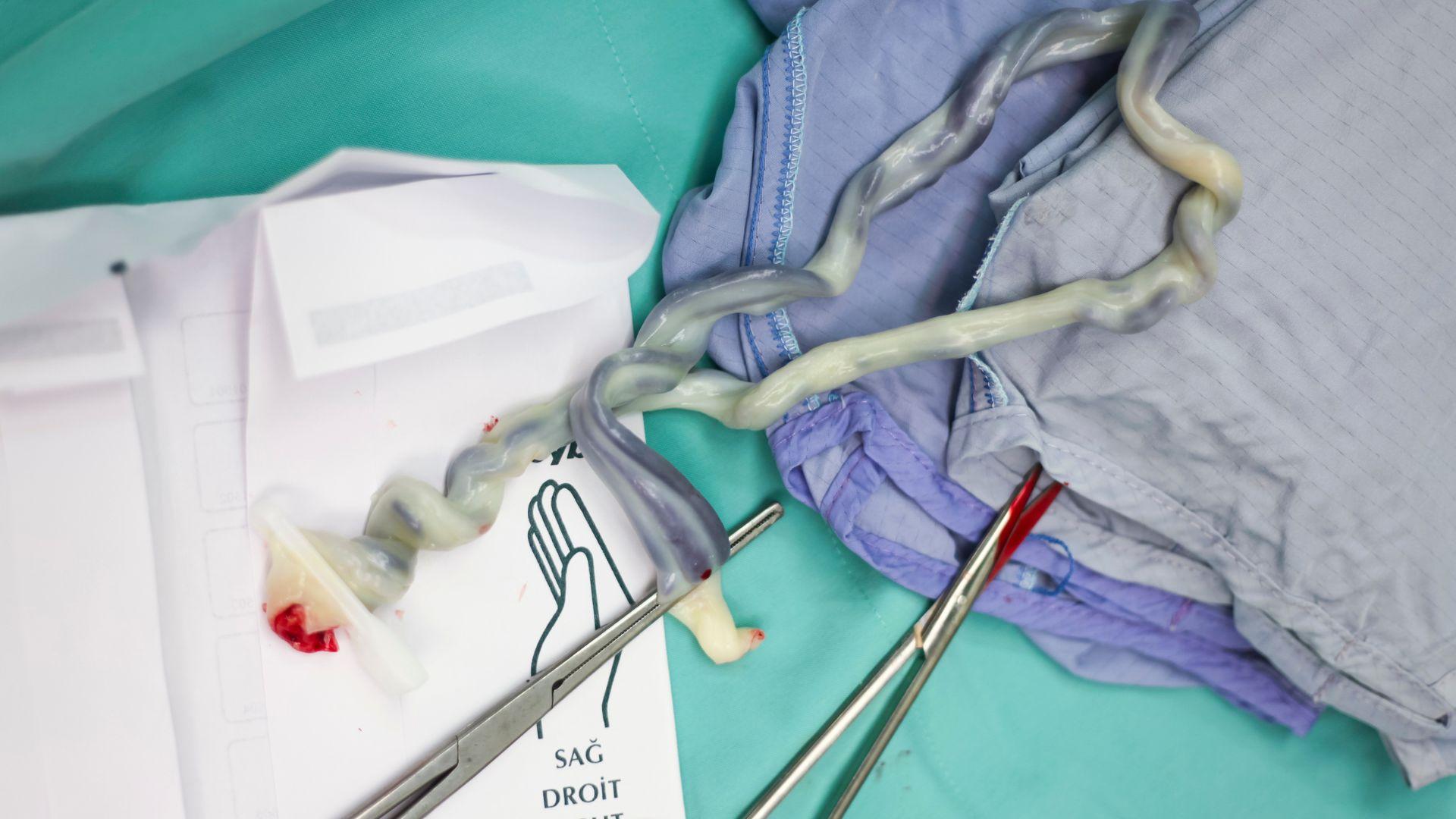 Dây rốn bám lệch tâm là gì? Những điều mẹ bầu cần biết