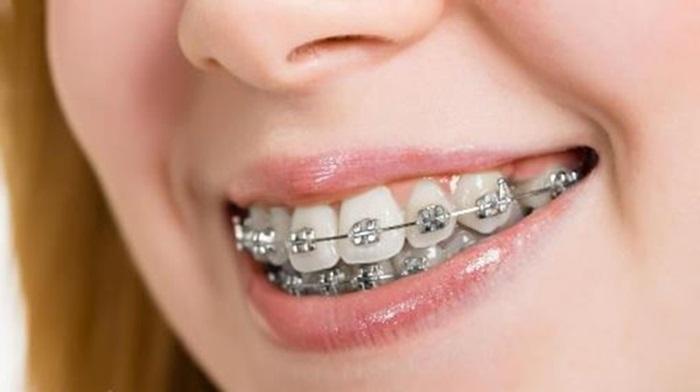 Niềng răng tiếng Anh là gì? Những thuật ngữ nha khoa thông dụng