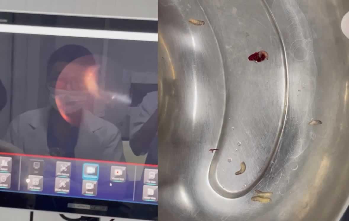 Hàng chục con giòi làm tổ trong tai bệnh nhân