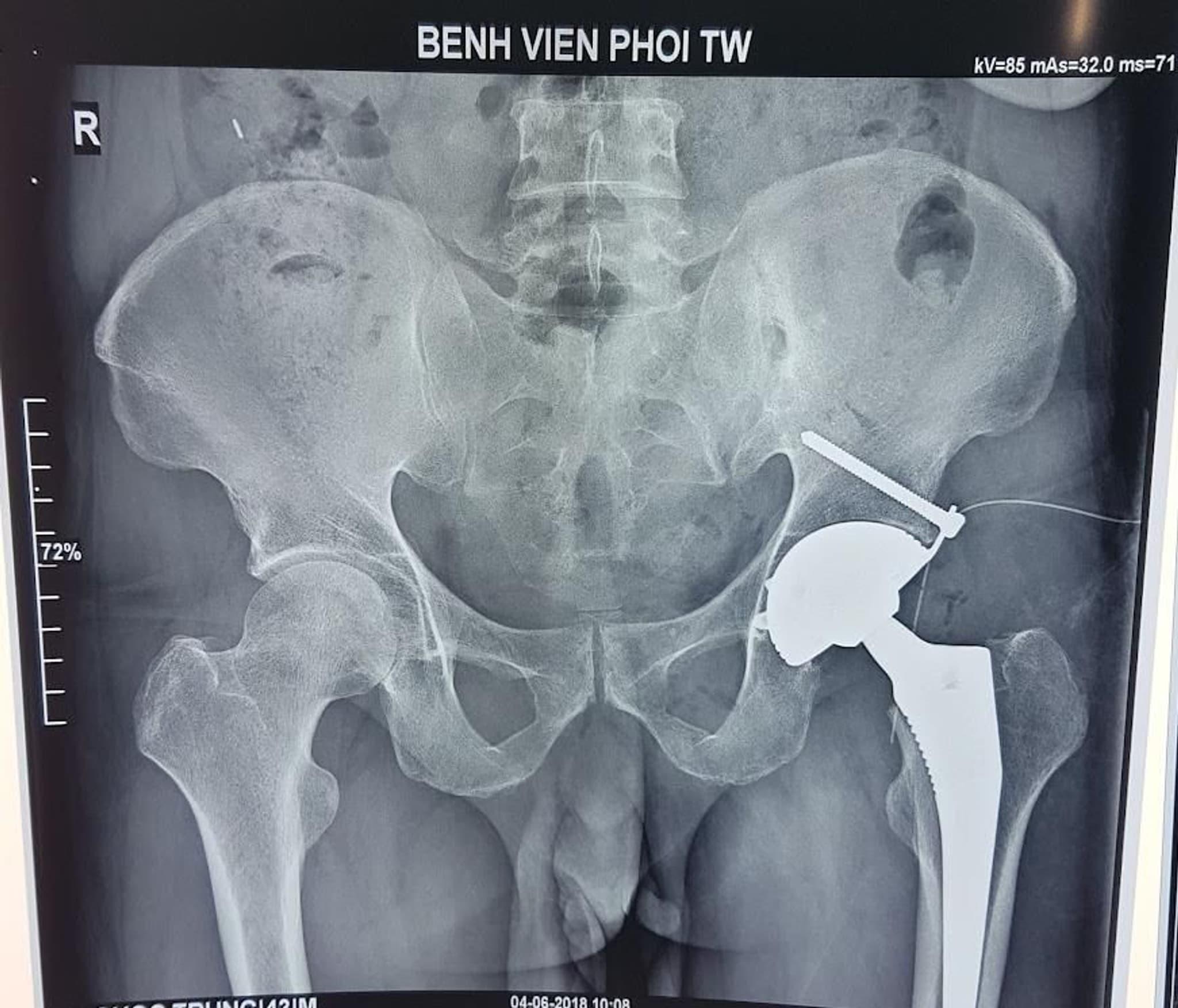 THAY KHỚP HÁNG NHÂN TẠO – BƯỚC ĐỘT PHÁ GIÚP NGƯỜI BỆNH LAO KHỚP HÁNG TÁI HÒA NHẬP CUỘC SỐNG BÌNH THƯỜNG