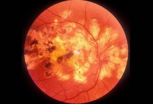 Đường huyết cao, bệnh tiểu đường và cơ thể của bạn