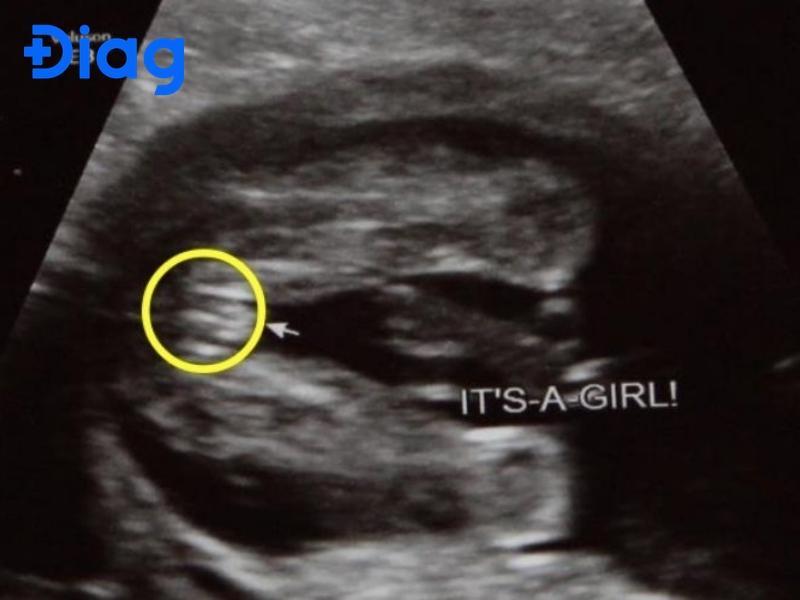 Hình ảnh siêu âm con gái: Dấu hiệu nhận biết và các yếu tố ảnh hưởng