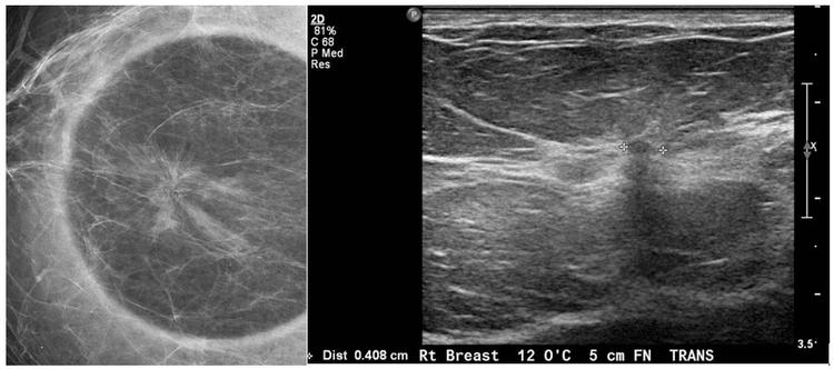 Đặc điểm hình ảnh sẹo tỏa tia của vú