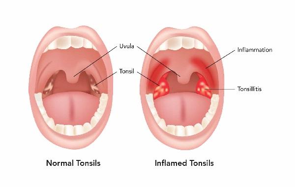 Viêm amidan hốc mủ: Triệu chứng, nguyên nhân, cách điều trị